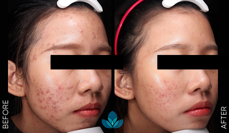 Mụn trứng cá
