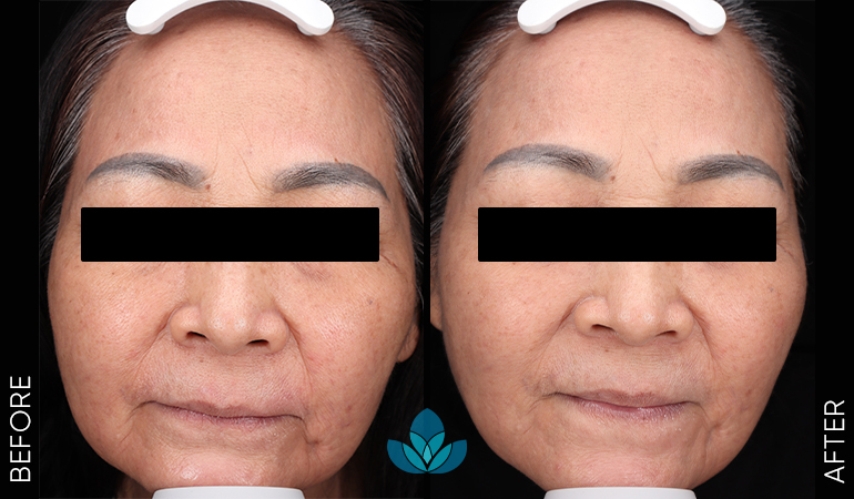 Trẻ hóa công nghệ cao